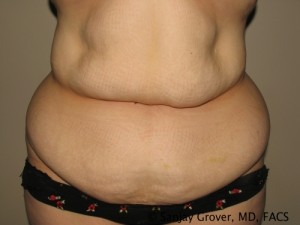 Tummy Tuck Before and After 25 | Sanjay Grover MD FACS