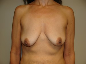 Breast Lift Before and After 05 | Sanjay Grover MD FACS
