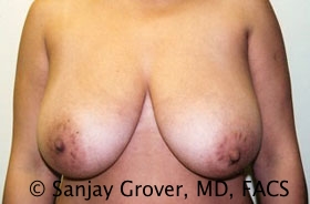 Breast Reduction Before and After 01 | Sanjay Grover MD FACS