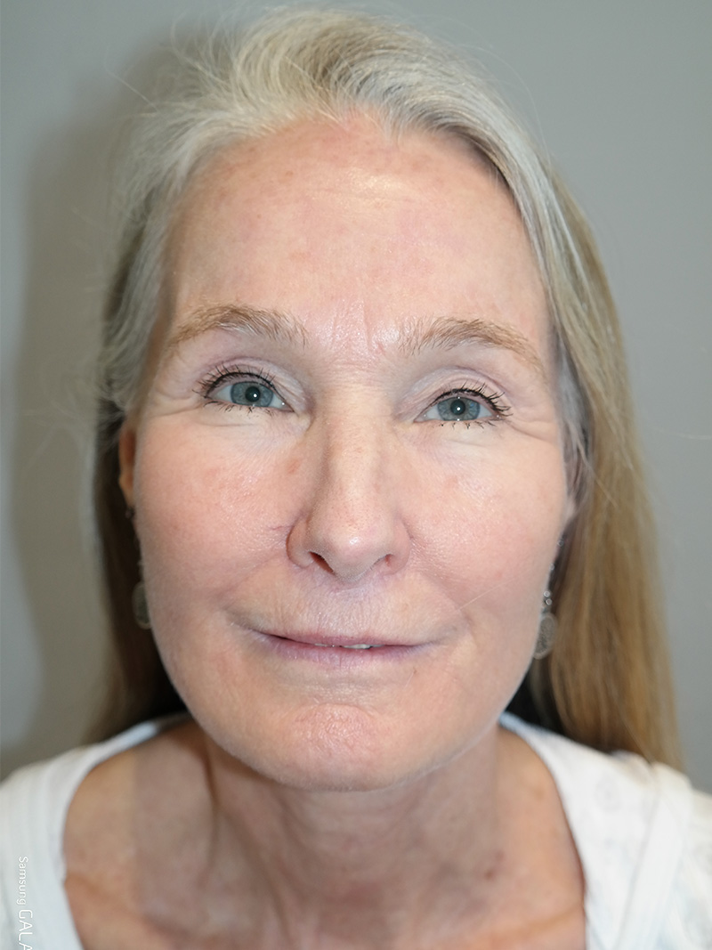 Facelift Before and After 03 | Sanjay Grover MD FACS