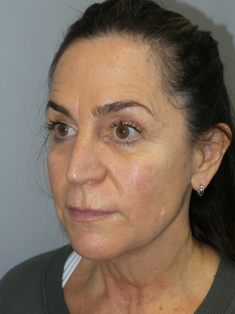 Facelift Before and After 07 | Sanjay Grover MD FACS