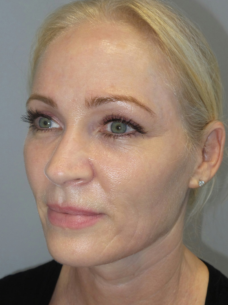 Facelift Before and After 08 | Sanjay Grover MD FACS