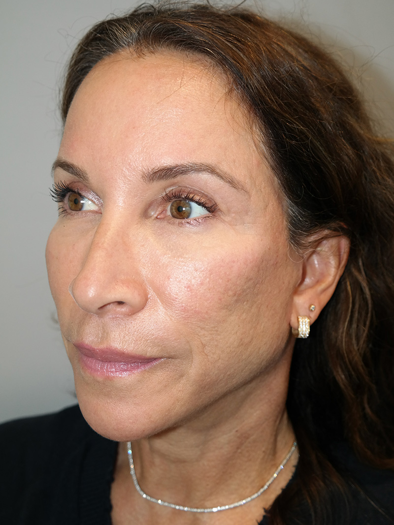 Facelift Before and After 11 | Sanjay Grover MD FACS