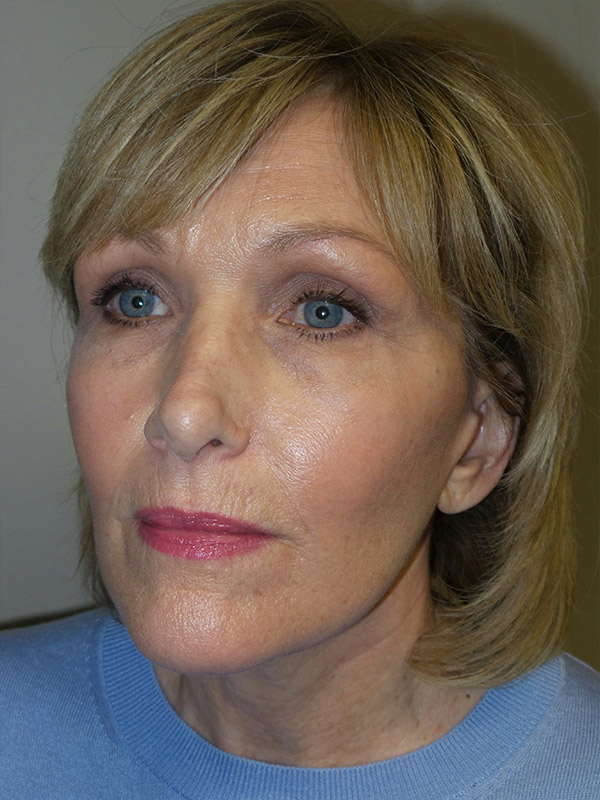 Facelift Before and After 13 | Sanjay Grover MD FACS