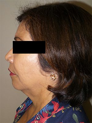 Facelift Before and After 18 | Sanjay Grover MD FACS