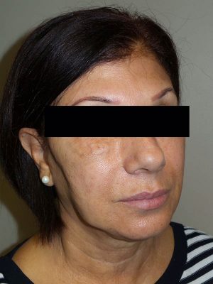 Facelift Before and After 08 | Sanjay Grover MD FACS