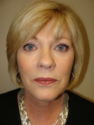 Facelift Before and After 20 | Sanjay Grover MD FACS