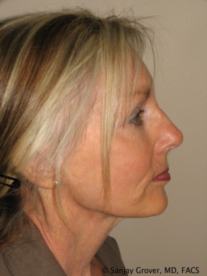 Facelift Before and After 22 | Sanjay Grover MD FACS