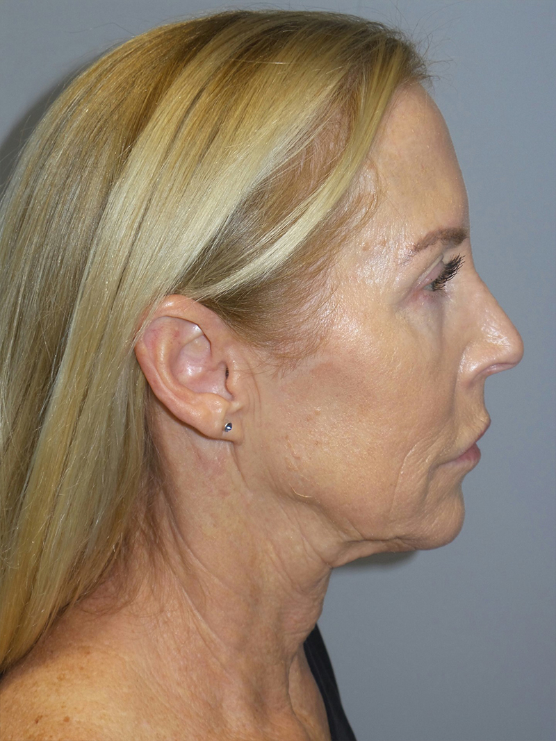 Facelift Before and After 31 | Sanjay Grover MD FACS