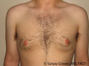 Gynecomastia Before and After 06 | Sanjay Grover MD FACS