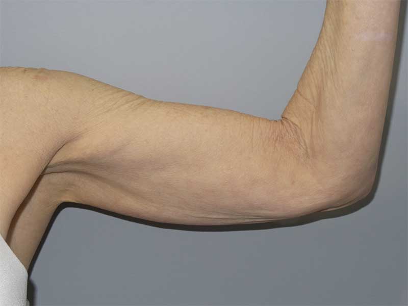 Arm Lift Before and After | Grover Aesthetics