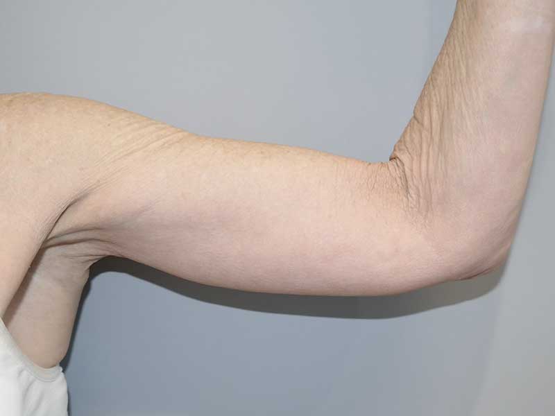 Arm Lift Before and After | Grover Aesthetics