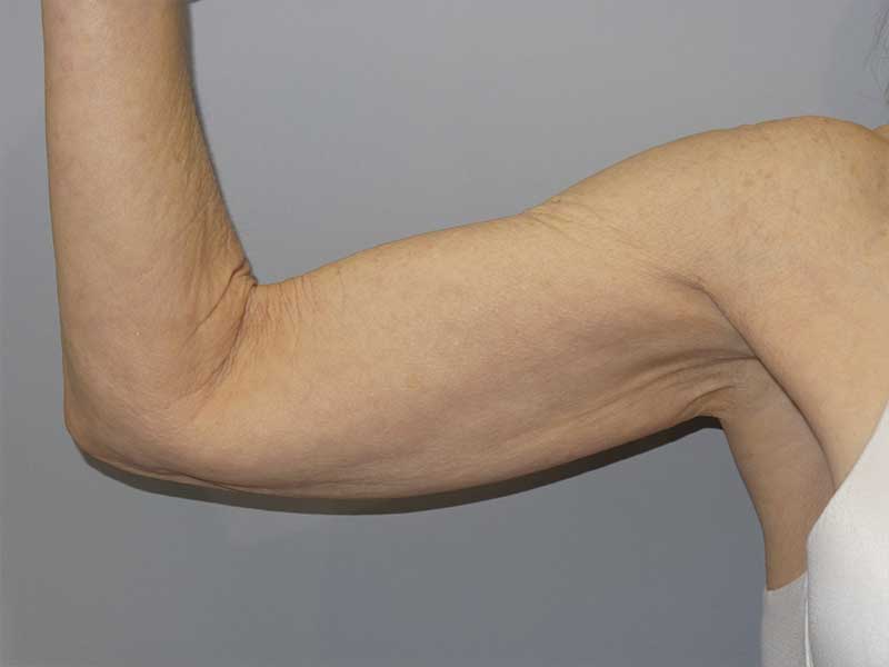Arm Lift Before and After 01 | Grover Aesthetics