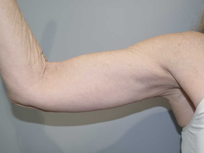 Arm Lift Before and After 01 | Grover Aesthetics