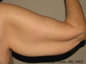 Arm Lift Before and After | Grover Aesthetics