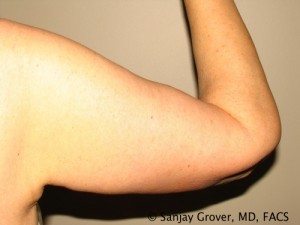 Arm Lift Before and After | Grover Aesthetics