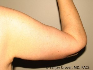 Arm Lift Before and After | Sanjay Grover MD FACS