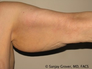 Arm Lift Before and After 02 | Grover Aesthetics