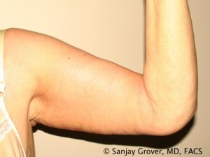 Arm Lift Before and After 02 | Grover Aesthetics