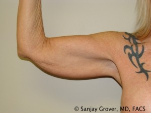 Arm Lift Before and After | Grover Aesthetics