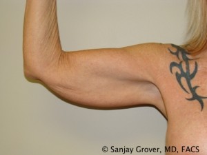 Arm Lift Before and After 06 | Sanjay Grover MD FACS