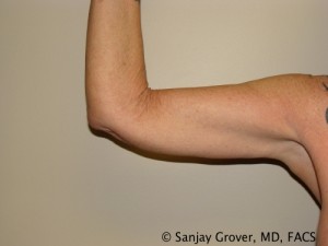 Arm Lift Before and After | Grover Aesthetics