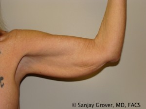 Arm Lift Before and After 03 | Sanjay Grover MD FACS