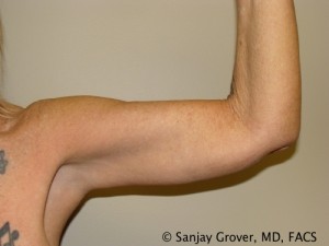 Arm Lift Before and After 03 | Grover Aesthetics