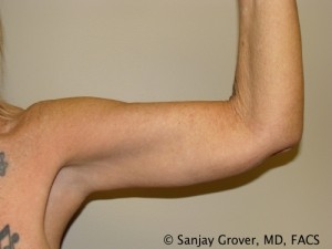 Arm Lift Before and After 03 | Sanjay Grover MD FACS