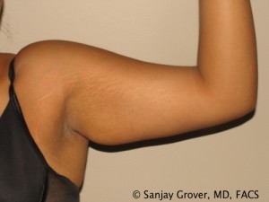 Arm Lift Before and After | Grover Aesthetics