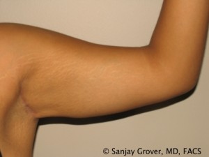 Arm Lift Before and After | Grover Aesthetics