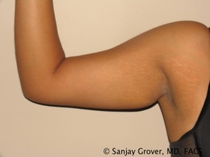 Arm Lift Before and After 04 | Grover Aesthetics