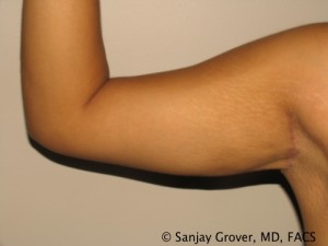 Arm Lift Before and After 04 | Grover Aesthetics