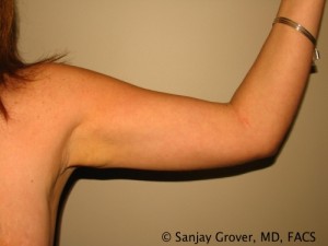 Arm Lift Before and After | Grover Aesthetics
