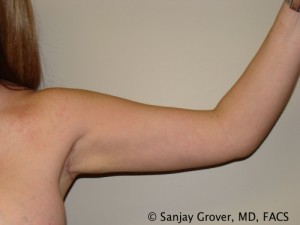 Arm Lift Before and After | Grover Aesthetics