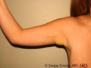 Arm Lift Before and After 05 | Grover Aesthetics