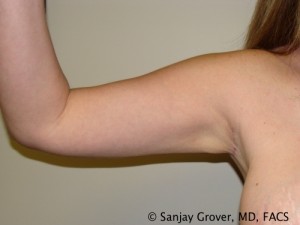 Arm Lift Before and After 05 | Grover Aesthetics