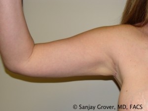 Arm Lift Before and After 05 | Sanjay Grover MD FACS