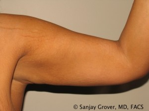 Arm Lift Before and After | Grover Aesthetics