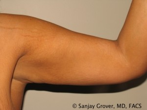 Arm Lift Before and After 07 | Sanjay Grover MD FACS