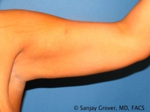 Arm Lift Before and After | Grover Aesthetics