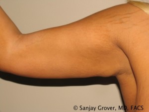 Arm Lift Before and After 06 | Grover Aesthetics