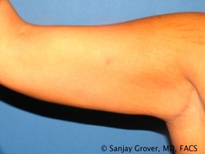 Arm Lift Before and After 06 | Sanjay Grover MD FACS