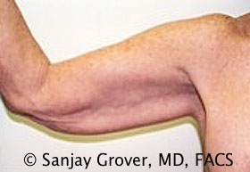 Arm Lift Before and After | Grover Aesthetics