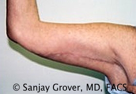 Arm Lift Before and After | Grover Aesthetics