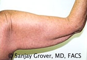 Arm Lift Before and After 07 | Sanjay Grover MD FACS