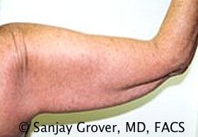 Arm Lift Before and After 07 | Grover Aesthetics