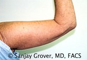 Arm Lift Before and After 07 | Grover Aesthetics