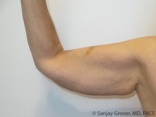 Arm Lift Before and After | Grover Aesthetics