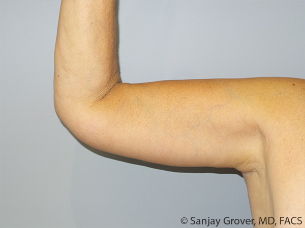 Arm Lift Before and After | Grover Aesthetics